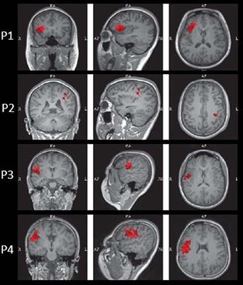 Pilot Study of Voxel-Based Morphometric MRI Post-processing in Patients With Non-lesional Operculoinsular Epilepsy